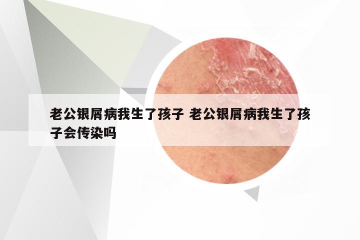 老公银屑病我生了孩子 老公银屑病我生了孩子会传染吗
