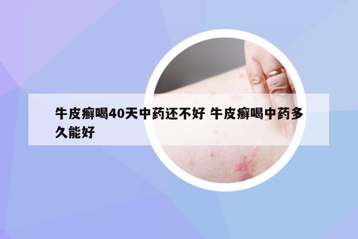 牛皮癣喝40天中药还不好 牛皮癣喝中药多久能好