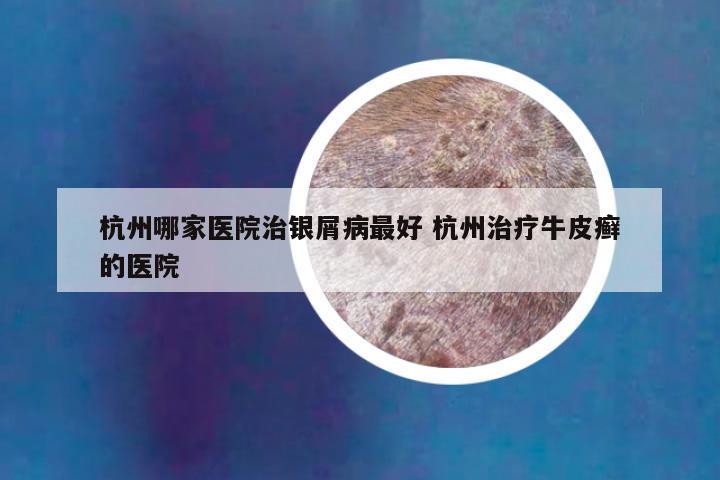 杭州哪家医院治银屑病最好 杭州治疗牛皮癣的医院