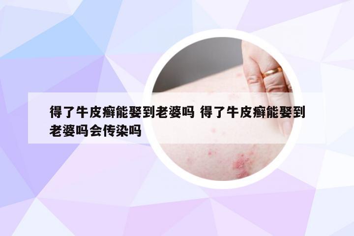 得了牛皮癣能娶到老婆吗 得了牛皮癣能娶到老婆吗会传染吗