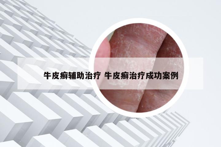 牛皮癣辅助治疗 牛皮癣治疗成功案例