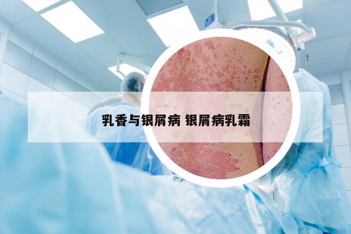 乳香与银屑病 银屑病乳霜