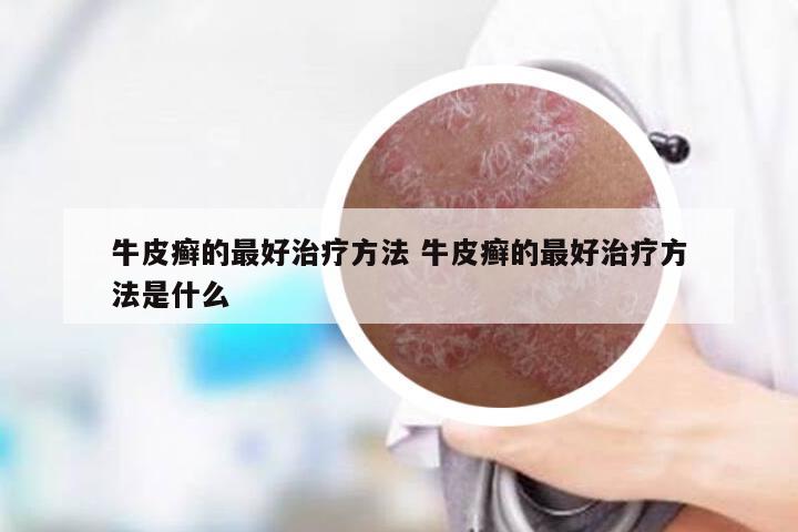 牛皮癣的最好治疗方法 牛皮癣的最好治疗方法是什么