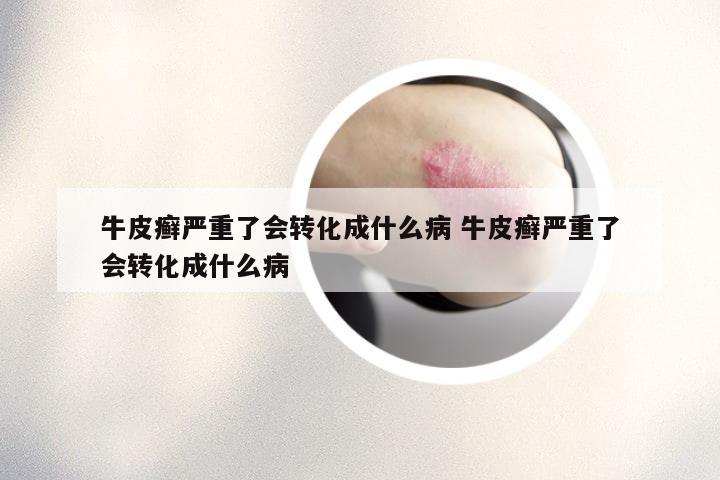 牛皮癣严重了会转化成什么病 牛皮癣严重了会转化成什么病