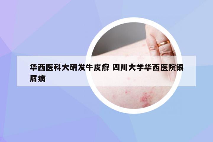 华西医科大研发牛皮癣 四川大学华西医院银屑病