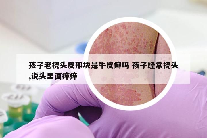 孩子老挠头皮那块是牛皮癣吗 孩子经常挠头,说头里面痒痒