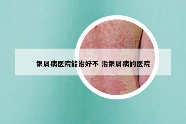 银屑病医院能治好不 治银屑病的医院