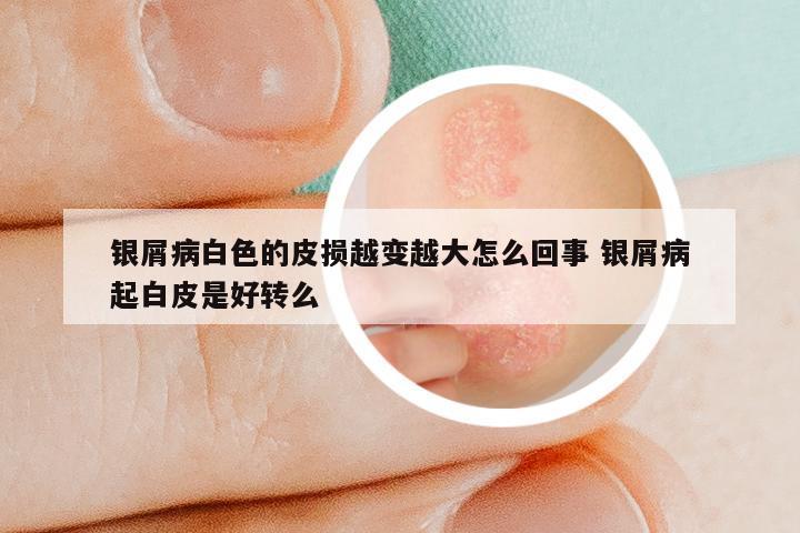 银屑病白色的皮损越变越大怎么回事 银屑病起白皮是好转么