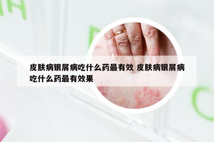 皮肤病银屑病吃什么药最有效 皮肤病银屑病吃什么药最有效果