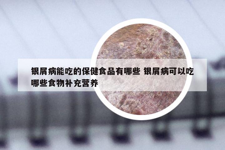 银屑病能吃的保健食品有哪些 银屑病可以吃哪些食物补充营养