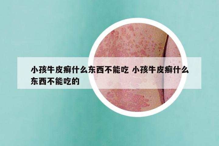 小孩牛皮癣什么东西不能吃 小孩牛皮癣什么东西不能吃的