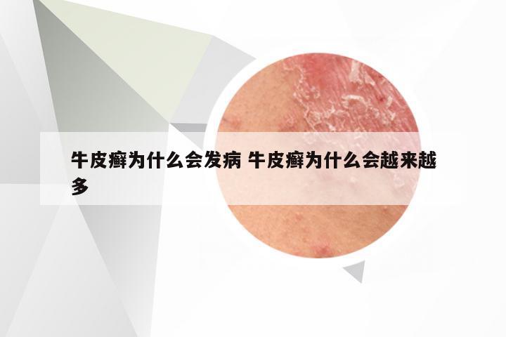 牛皮癣为什么会发病 牛皮癣为什么会越来越多