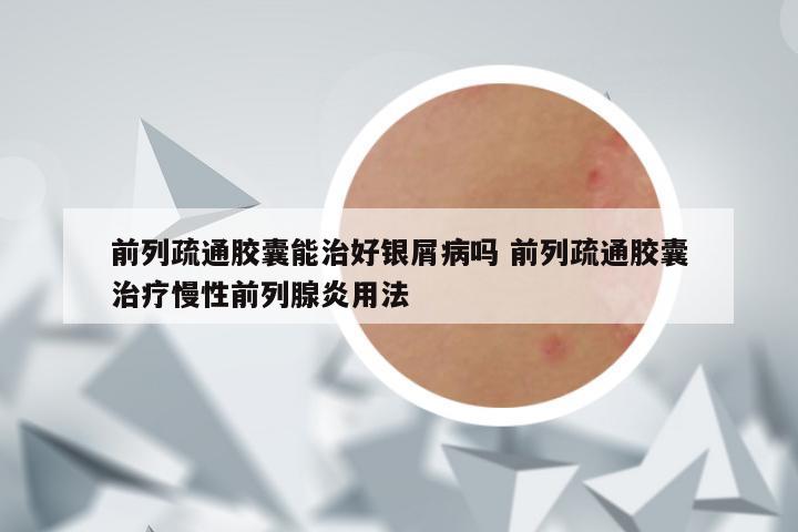 前列疏通胶囊能治好银屑病吗 前列疏通胶囊治疗慢性前列腺炎用法