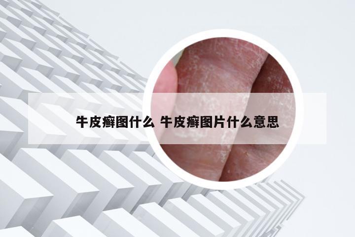牛皮癣图什么 牛皮癣图片什么意思