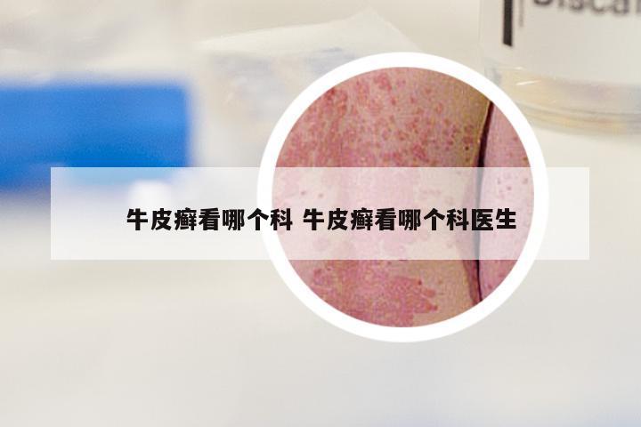 牛皮癣看哪个科 牛皮癣看哪个科医生
