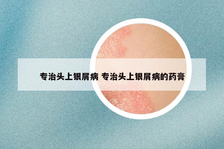 专治头上银屑病 专治头上银屑病的药膏