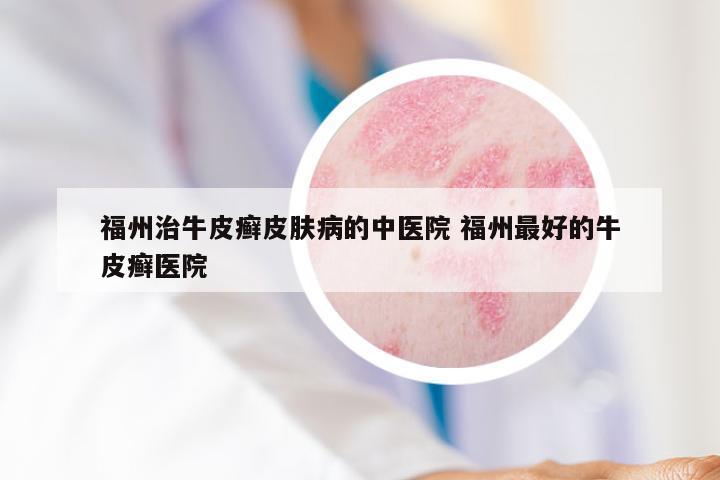 福州治牛皮癣皮肤病的中医院 福州最好的牛皮癣医院