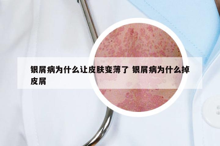 银屑病为什么让皮肤变薄了 银屑病为什么掉皮屑