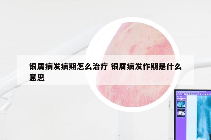 银屑病发病期怎么治疗 银屑病发作期是什么意思