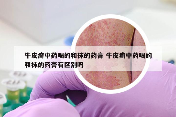 牛皮癣中药喝的和抹的药膏 牛皮癣中药喝的和抹的药膏有区别吗