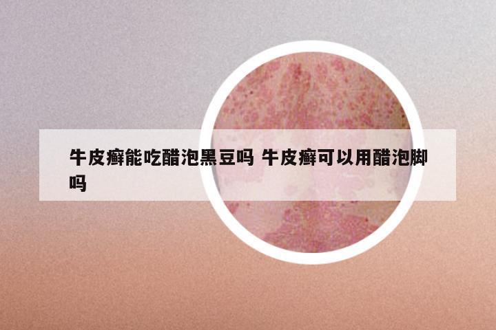 牛皮癣能吃醋泡黑豆吗 牛皮癣可以用醋泡脚吗