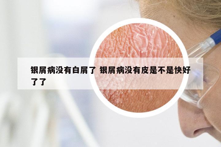 银屑病没有白屑了 银屑病没有皮是不是快好了了