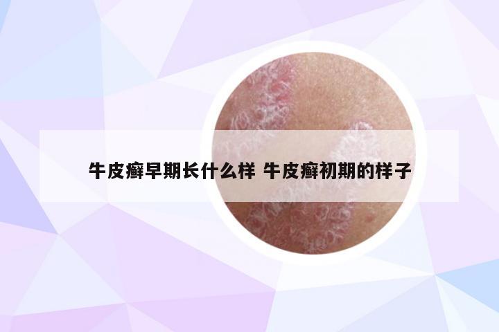 牛皮癣早期长什么样 牛皮癣初期的样子