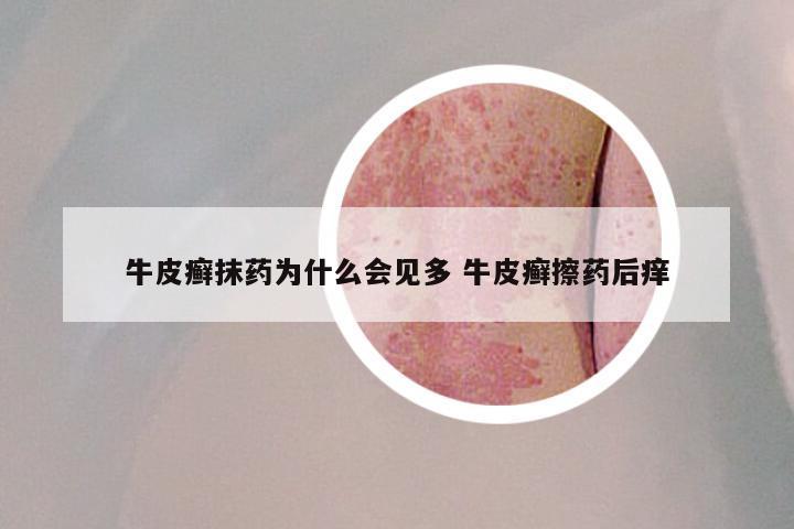 牛皮癣抹药为什么会见多 牛皮癣擦药后痒