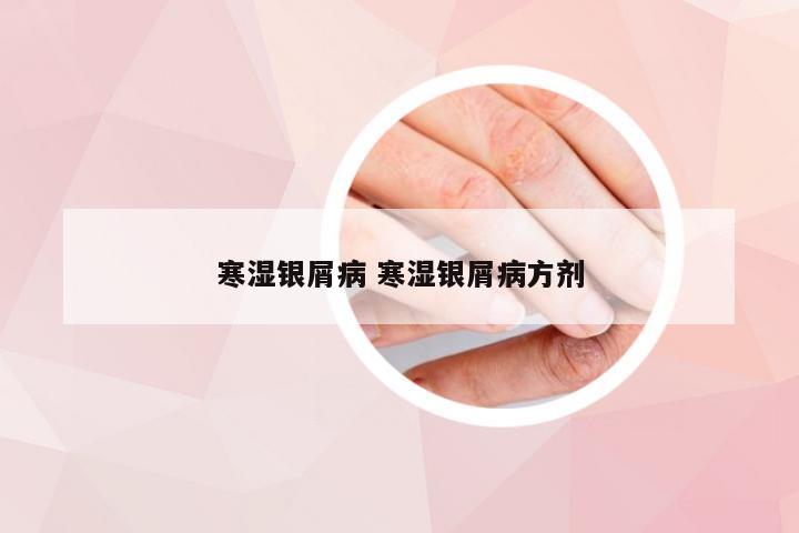 寒湿银屑病 寒湿银屑病方剂