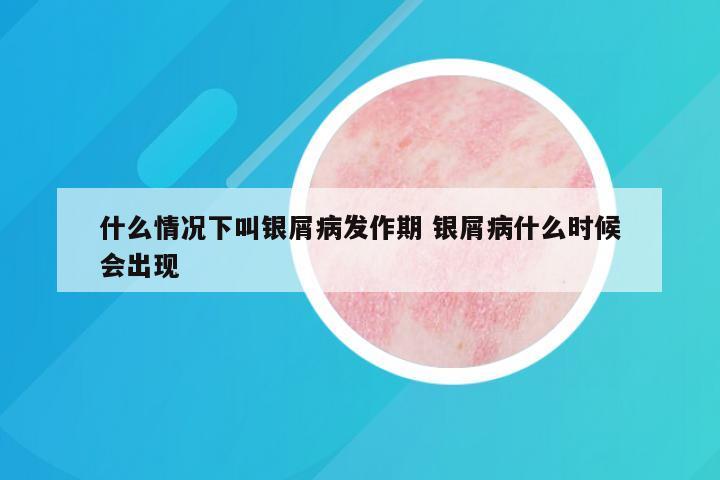 什么情况下叫银屑病发作期 银屑病什么时候会出现