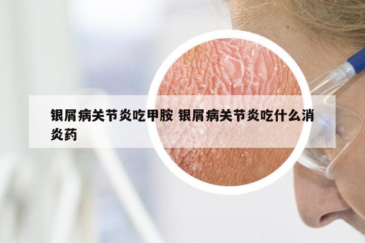 银屑病关节炎吃甲胺 银屑病关节炎吃什么消炎药