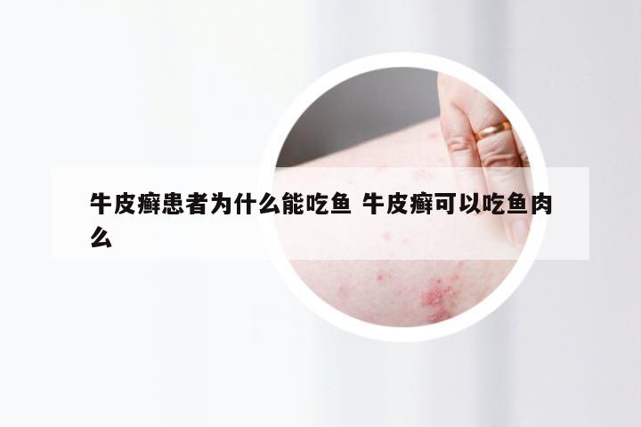 牛皮癣患者为什么能吃鱼 牛皮癣可以吃鱼肉么