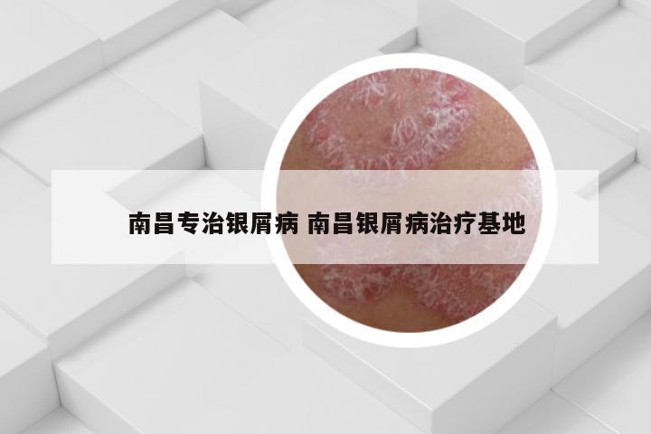 南昌专治银屑病 南昌银屑病治疗基地
