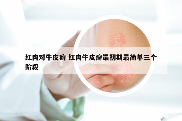 红肉对牛皮癣 红肉牛皮癣最初期最简单三个阶段
