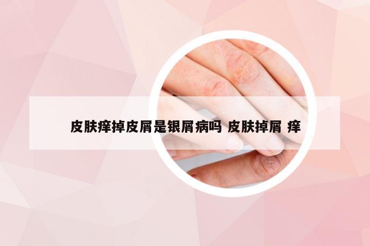 皮肤痒掉皮屑是银屑病吗 皮肤掉屑 痒