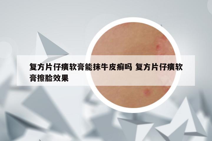复方片仔癀软膏能抹牛皮癣吗 复方片仔癀软膏擦脸效果