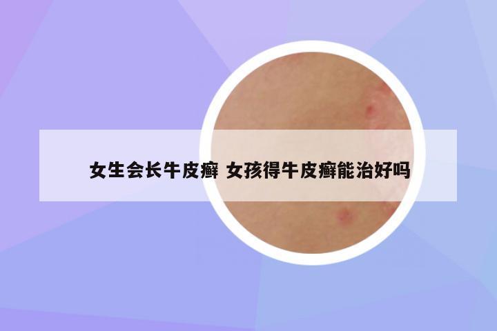 女生会长牛皮癣 女孩得牛皮癣能治好吗