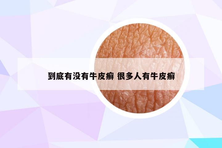 到底有没有牛皮癣 很多人有牛皮癣