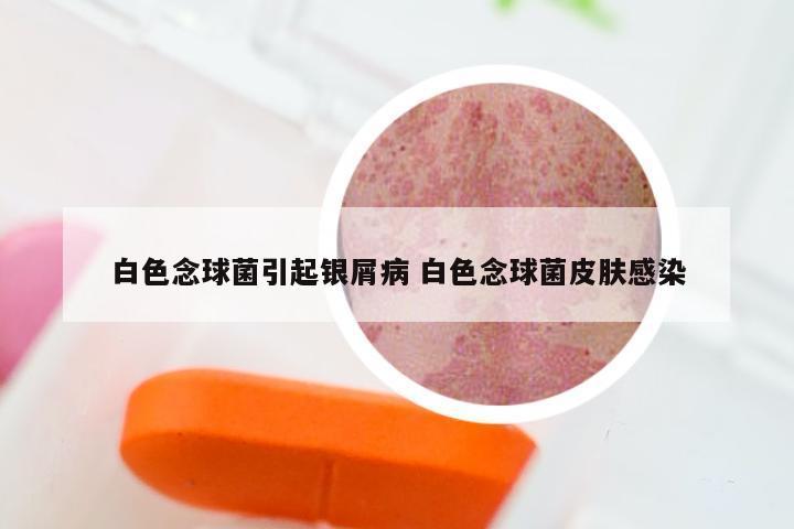 白色念球菌引起银屑病 白色念球菌皮肤感染