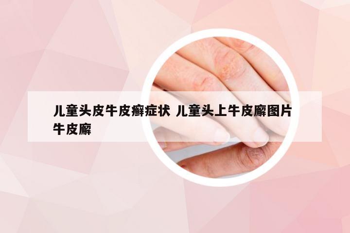 儿童头皮牛皮癣症状 儿童头上牛皮廨图片 牛皮廨