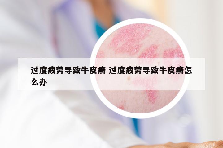 过度疲劳导致牛皮癣 过度疲劳导致牛皮癣怎么办
