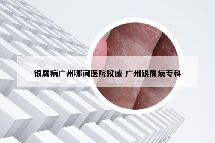银屑病广州哪间医院权威 广州银屑病专科