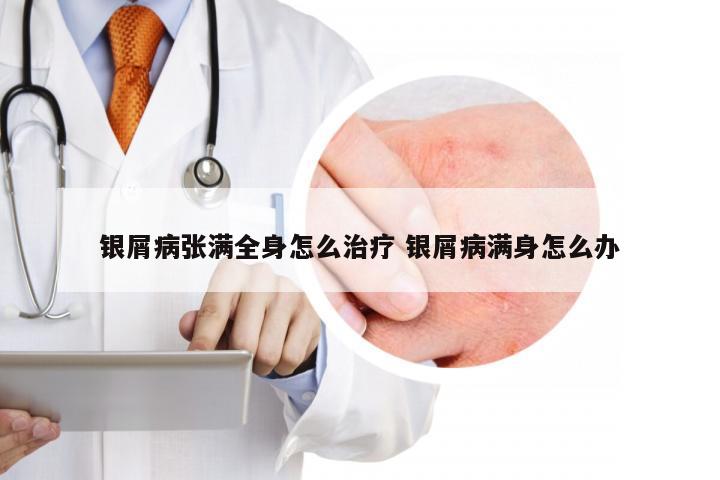 银屑病张满全身怎么治疗 银屑病满身怎么办