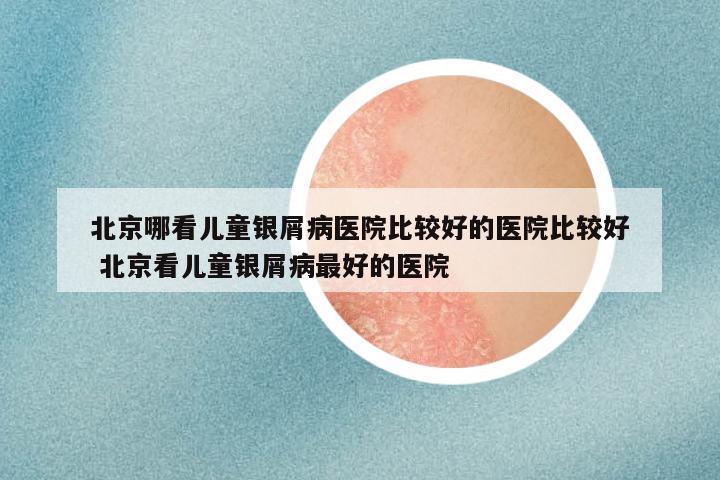 北京哪看儿童银屑病医院比较好的医院比较好 北京看儿童银屑病最好的医院