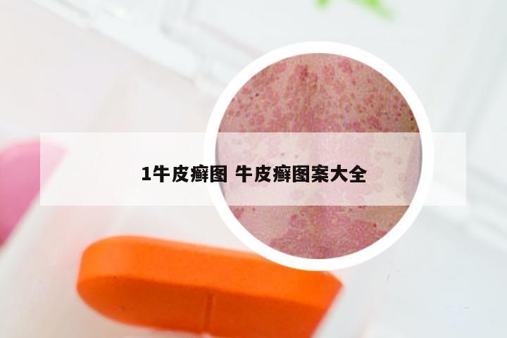 1牛皮癣图 牛皮癣图案大全