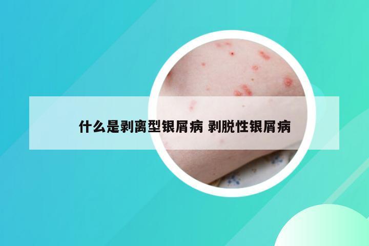 什么是剥离型银屑病 剥脱性银屑病