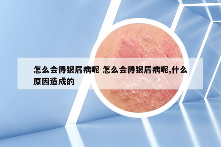 怎么会得银屑病呢 怎么会得银屑病呢,什么原因造成的