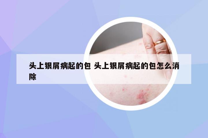 头上银屑病起的包 头上银屑病起的包怎么消除