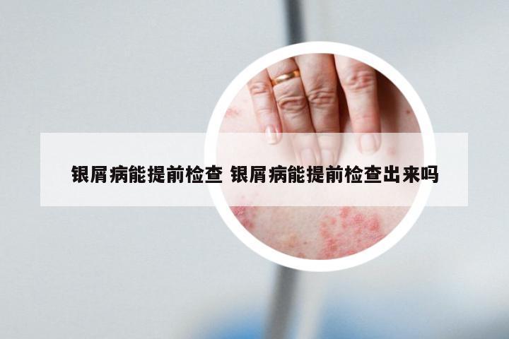 银屑病能提前检查 银屑病能提前检查出来吗