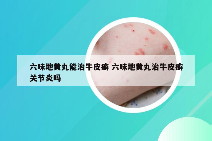 六味地黄丸能治牛皮癣 六味地黄丸治牛皮癣关节炎吗